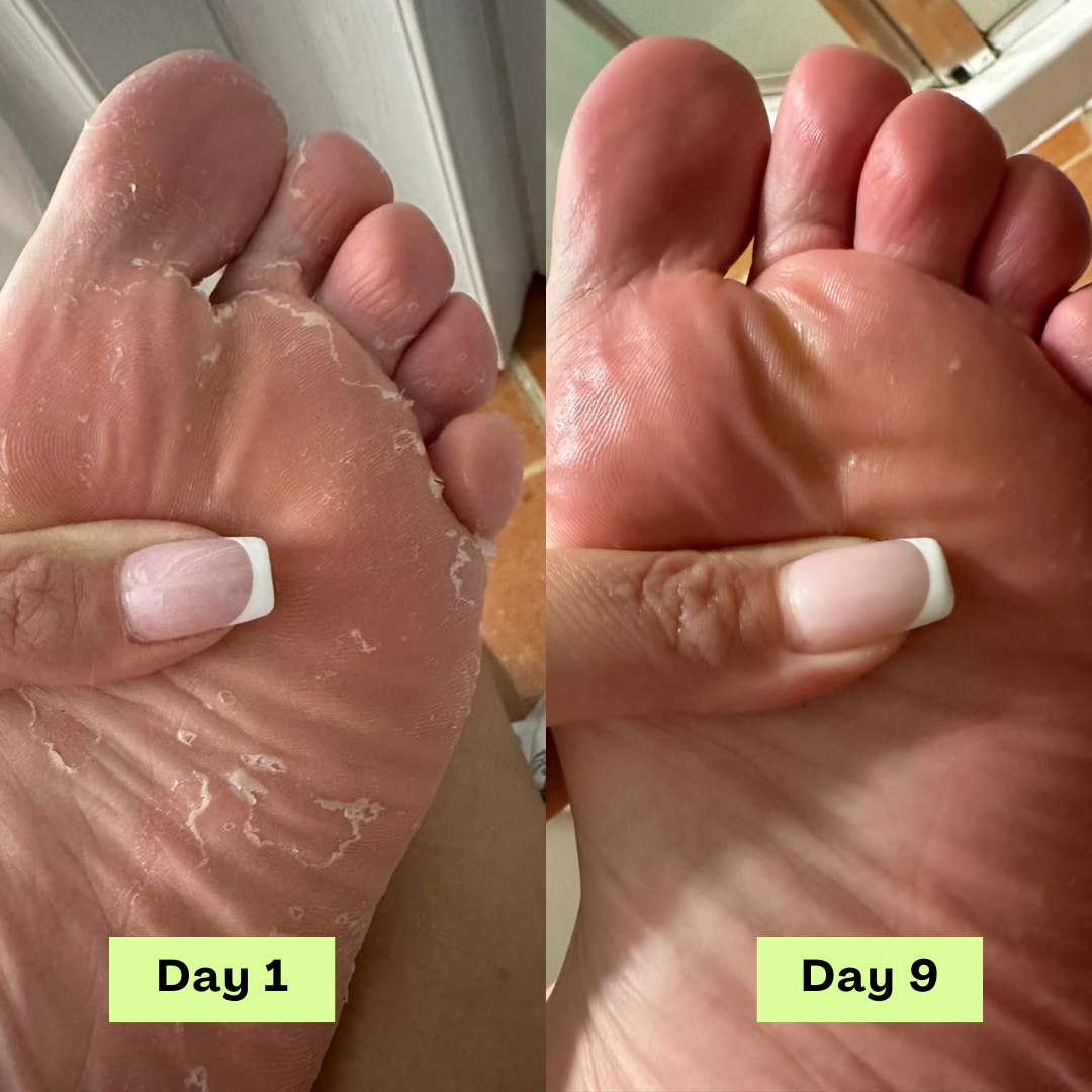 Zénitth AntiFungal Relief Soap Bar