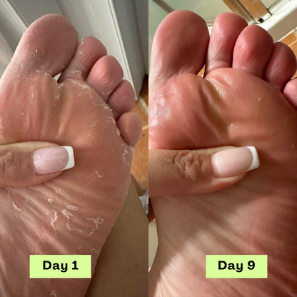 Zénitth AntiFungal Relief Soap Bar