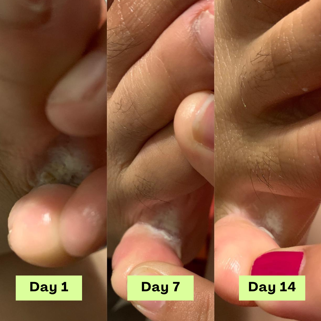 Zénitth AntiFungal Relief Soap Bar