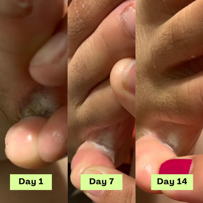 Zénitth AntiFungal Relief Soap Bar